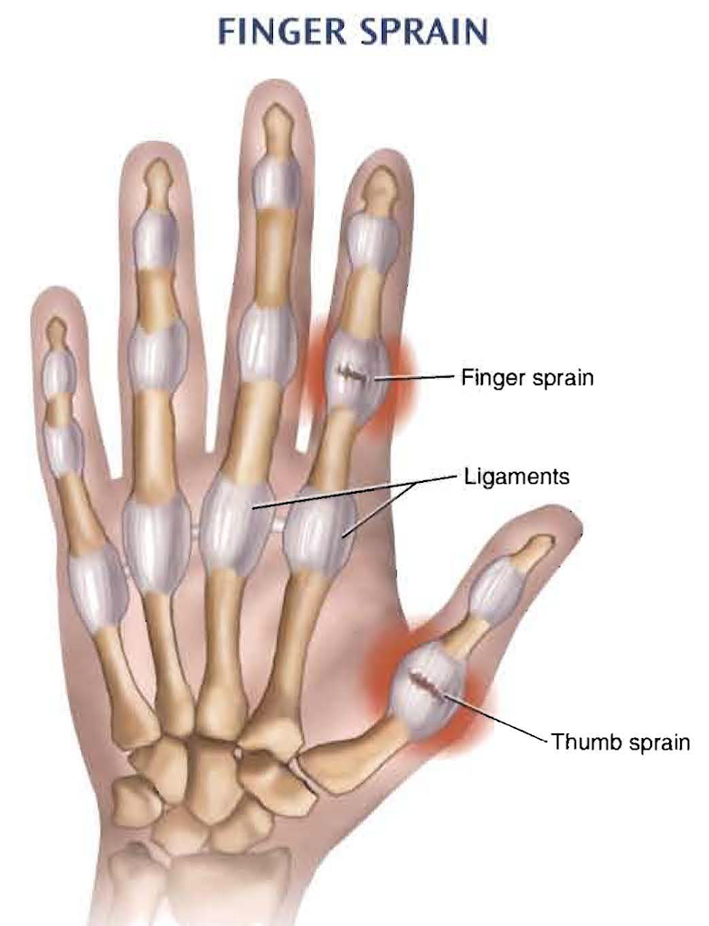 What Do Doctors Do For A Sprained Finger